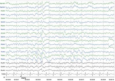 Case Report: Cerebral folate deficiency caused by FOLR1 variant